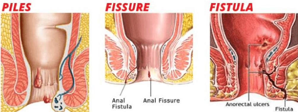 piles-fiss_16880431061hDNcB.png