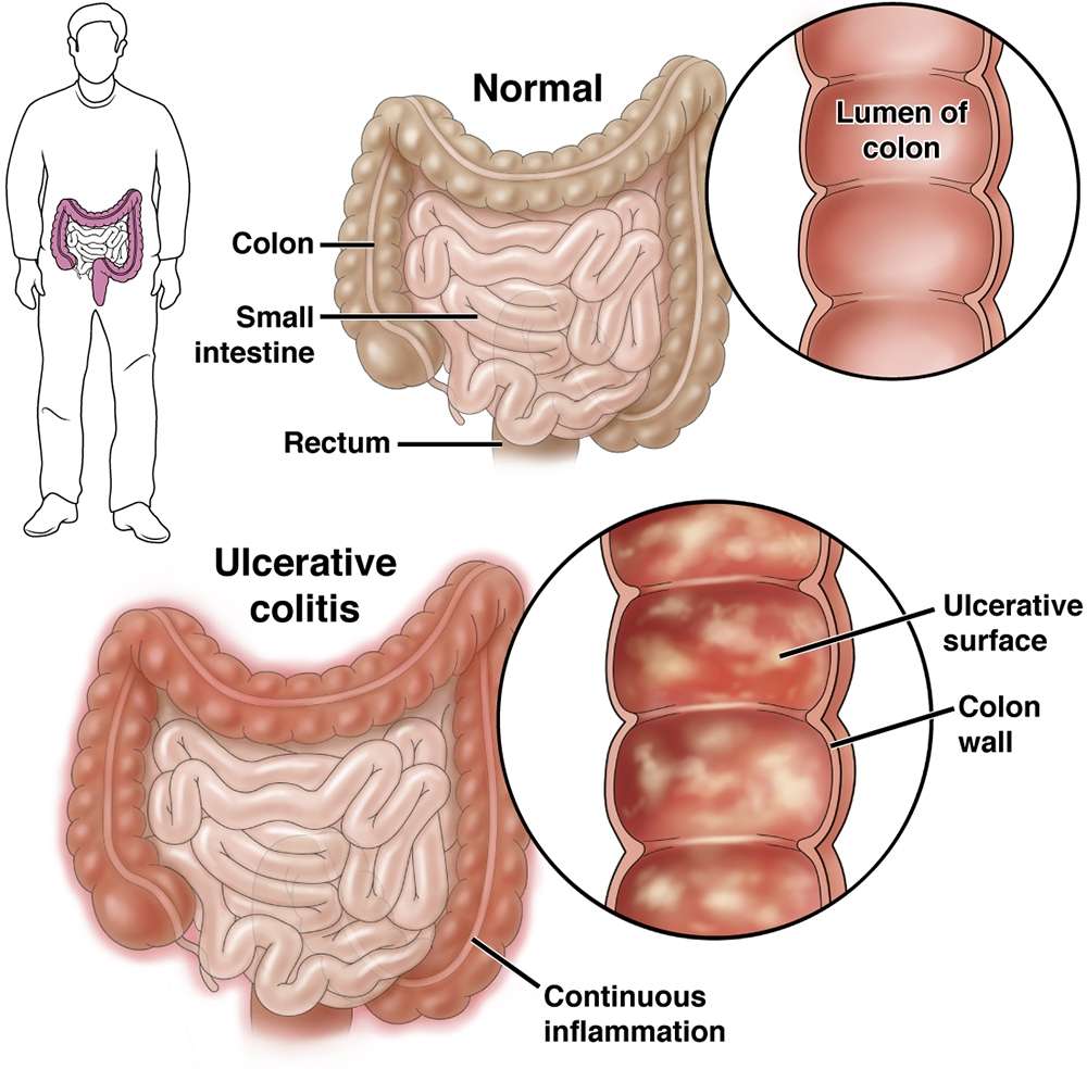 from-ulcer_168803110044YQw8.jpeg