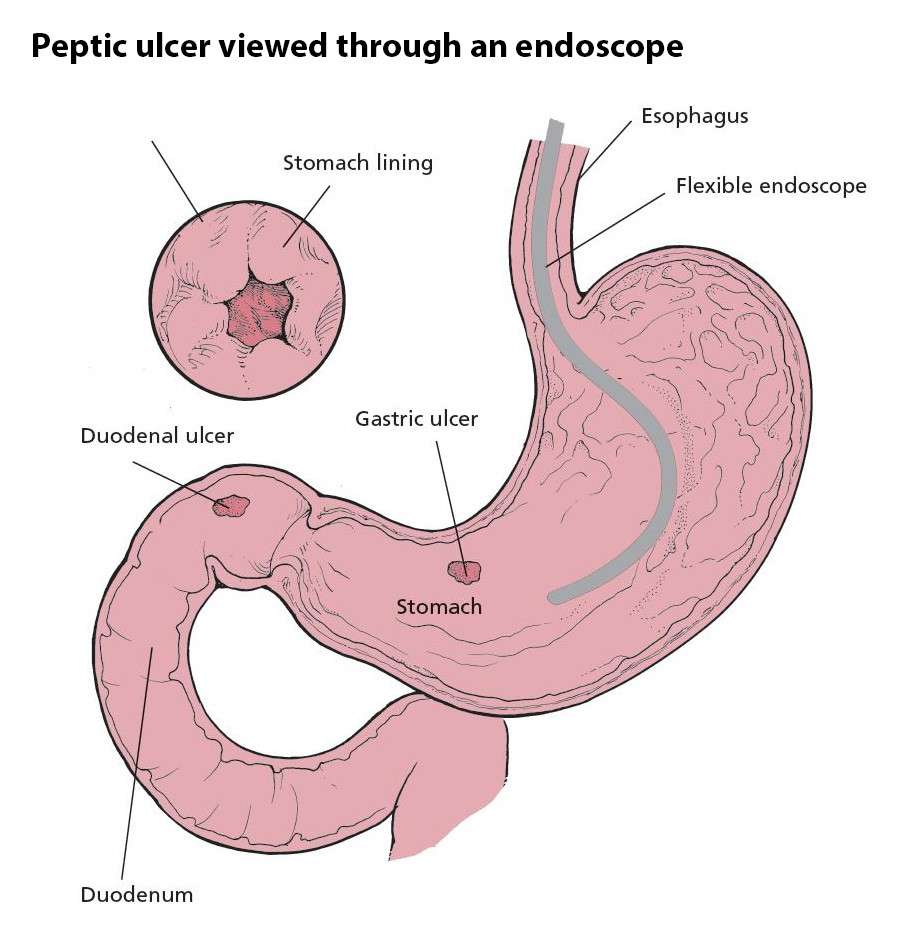 duodenal-u_16880331498FgvVY.jpeg