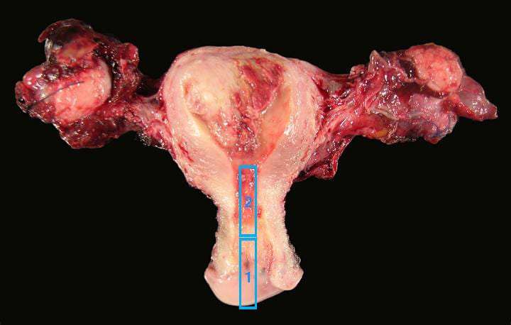 uterine-ca_1688115379xuT8Je.jpeg