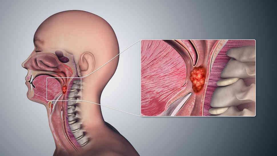 throat-can_1688115966lCidZh.jpeg