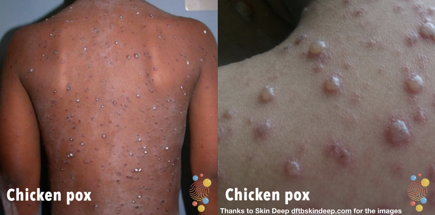 chickenpox_1688186528peuYCD.png