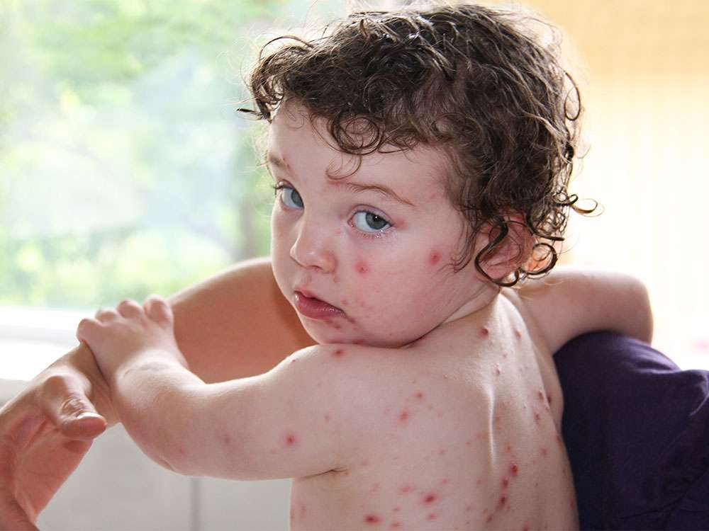 chickenpox_16881865290jliqB.jpeg