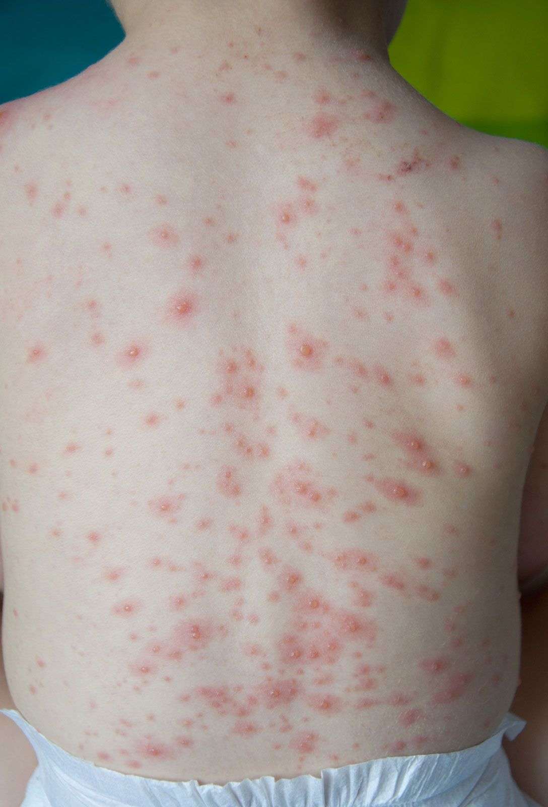 chickenpox_1688186529jQj1Cc.jpeg