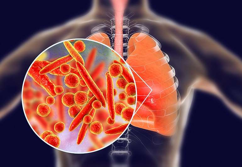 pneumonia_1688205938QrjTmA.jpeg