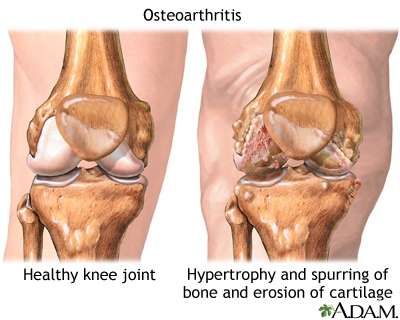 osteoarthr_1688207686VURSpE.jpeg