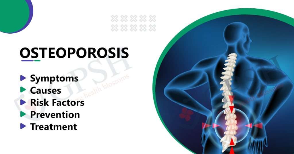 osteoporos_1688207934W2GcbC.jpeg