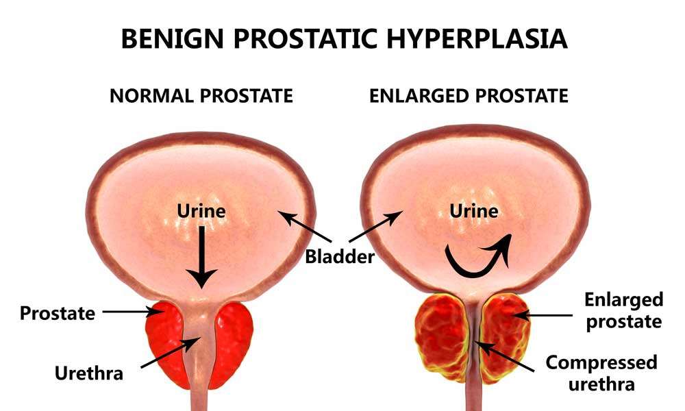 prostate-e_1688279236YV0nSj.jpeg