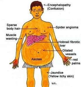 liver-cirr_16882795070PUuqp.jpeg
