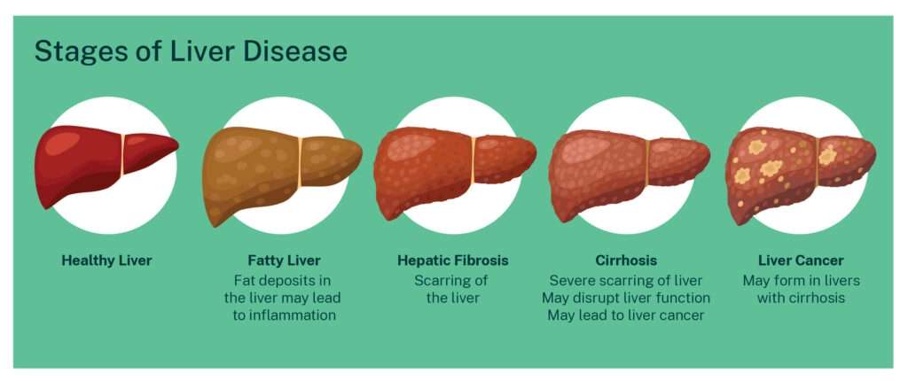 liver-cirr_1688279507MCbR9I.jpeg