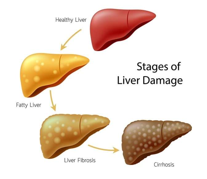 liver-cirr_1688279508C0JS3M.jpeg