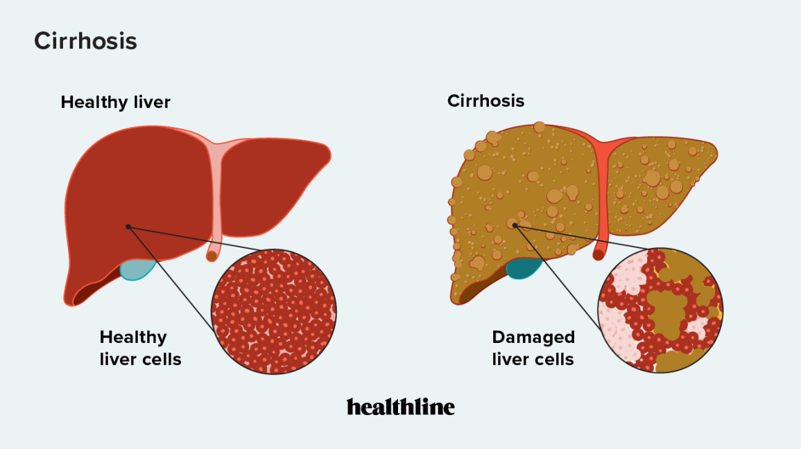 liver-cirr_1688279508IwPW0H.png