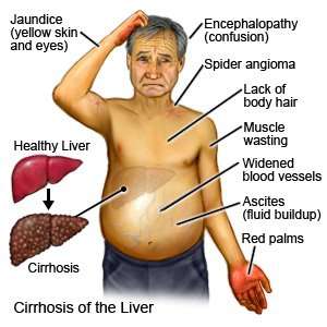 liver-cirr_1688279508WyWPkI.jpeg