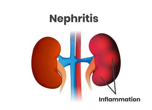 nephritis_1688279814NPIt4H.jpeg