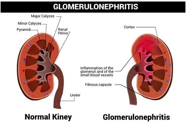 nephritis_168827981559EI4k.jpeg