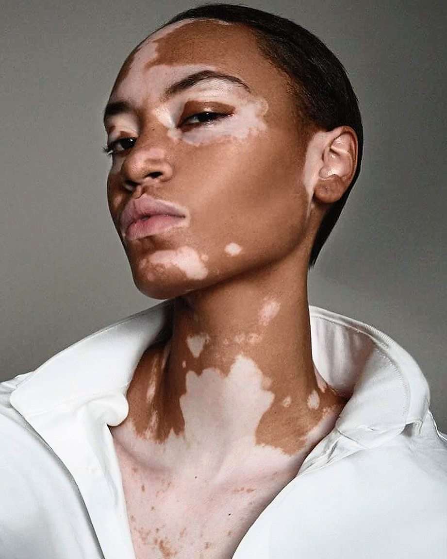 leucoderma_1688280956YPHSCc.jpeg