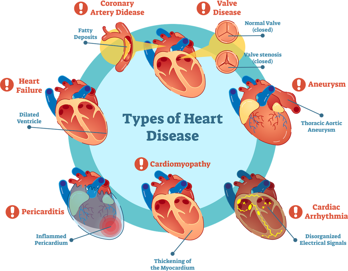 heart-dise_1688282639CelN1N.png