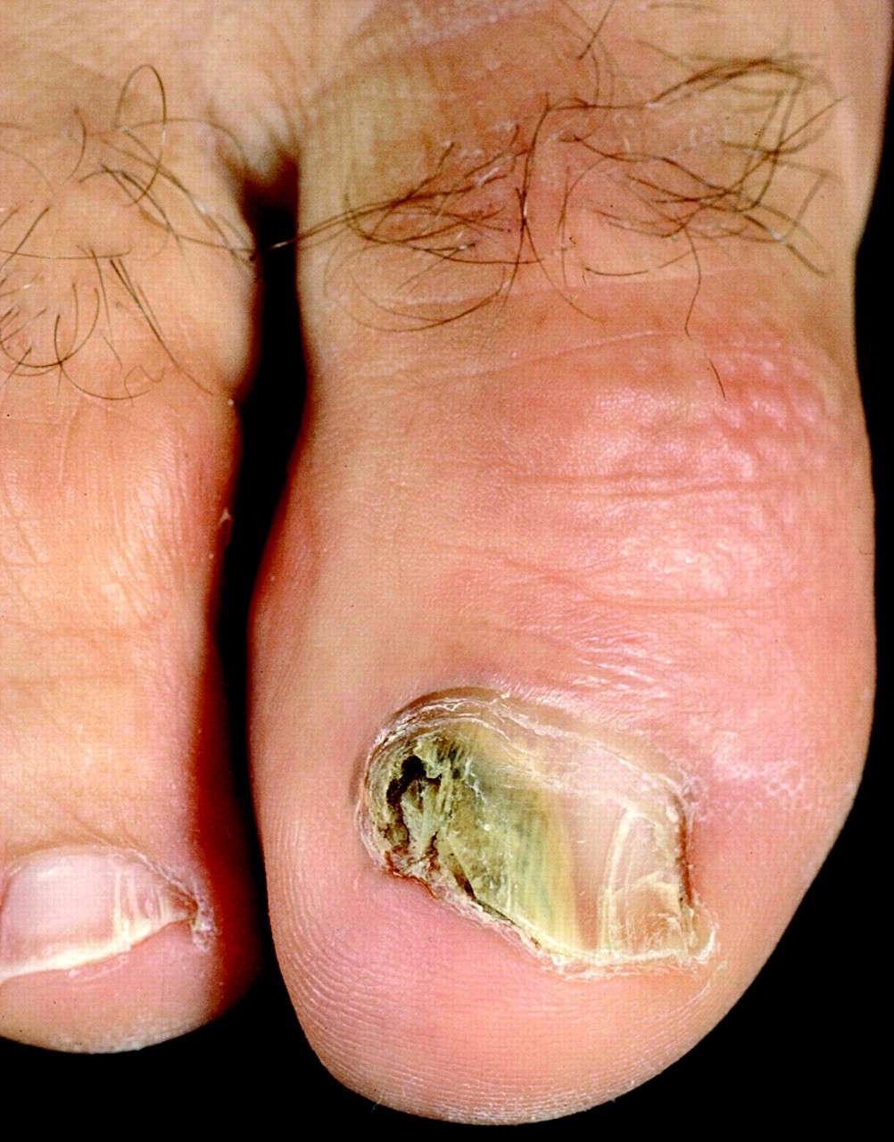 nail-fungu_1688282963PLUfHI.jpeg