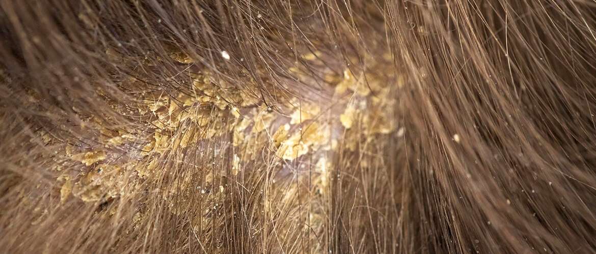 fungal-inf_1688283285eAE2bN.jpeg