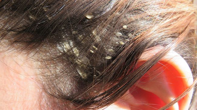 dandruff_16882835462seCMN.png