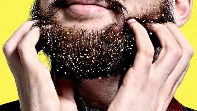 dandruff_1688283547hL5M8J.jpeg