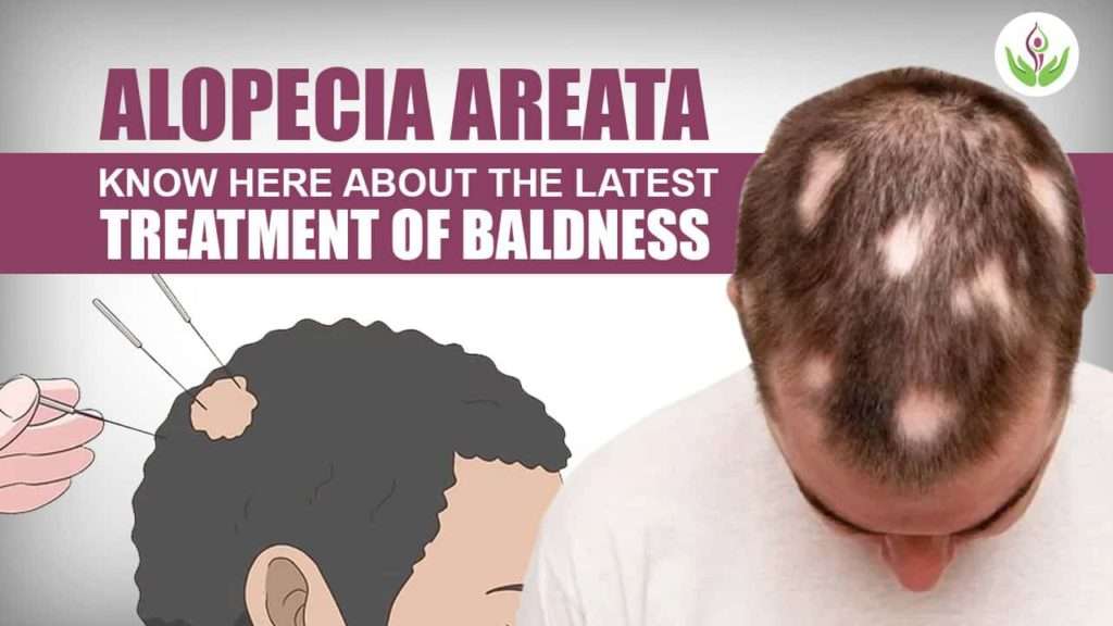 alopecia-a_1688284171ui88Ln.jpeg